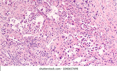 Lung Cancer - Adenocarcinoma: Therapies For Specific Genetic Mutations (biomarkers EGFR, ALK, ROS1, BRAF, PDL1, KRAS) Are Appropriate For Selected Cases.