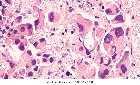 Lung Cancer - Adenocarcinoma: Therapies For Specific Genetic Mutations (biomarkers EGFR, ALK, ROS1, BRAF, PDL1, KRAS) Are Appropriate For Selected Cases.