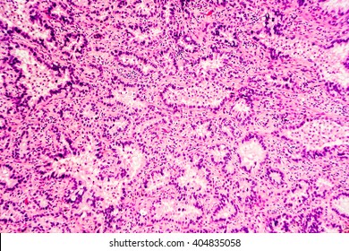 Lung cancer - adenocarcinoma: Therapies targeting specific genetic biomarkers such as EGFR, ALK and ROS1 are appropriate for selected cases (photographed and uploaded by US surgical pathologist).