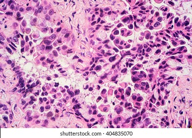 Lung cancer awareness - adenocarcinoma: Therapies targeting specific genetic alterations such as EGFR, ALK and ROS1 are appropriate for selected cases  (uploaded by US surgical pathologist).