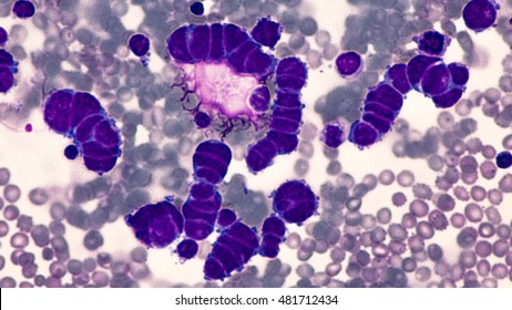 Lung Cancer Awareness; Microscopic image of pleural fluid cytology of a small cell (oat cell) carcinoma from a patient with a history of smoking, demonstrating characteristic nuclear molding.   
