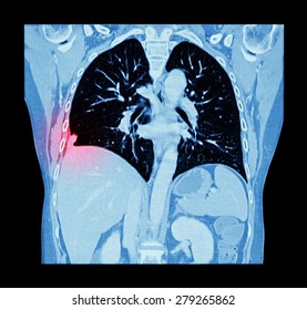 Lung Cancer ( CT Scan Of Chest And Abdomen : Show Right Lung Cancer ) ( Coronal Plane )