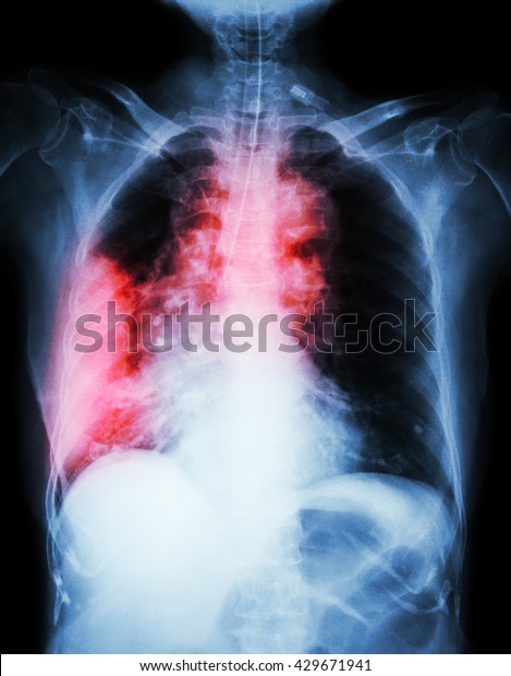 Lung Cancer Film Chest Xray Show Stock Photo (Edit Now) 429671941