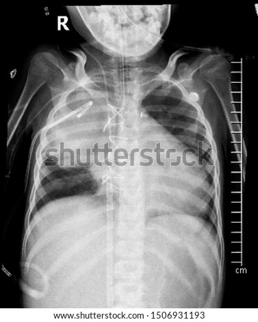 Lung cancer on Chest X-ray.
