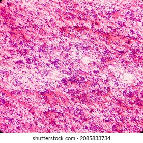 Lung Cancer, Photomicrograph Of Small Cell Carcinoma, Malignant Cells, Sample Sapirate From Lung Mass By CT Guided FNA, Show Atypical Small Round Cells, Granular Salt Pepper Chromatin