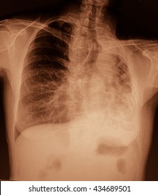 Lung Cancer, Pleural Effusion