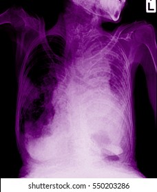 Lung Cancer, Pleural Effusion