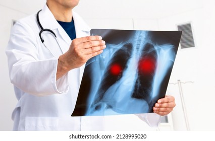 Lung Cancer Or Pneumonia. Doctor Check Up X-ray Image Have Problem Lung Tumor Of Patient Or Long Covid At Hospital