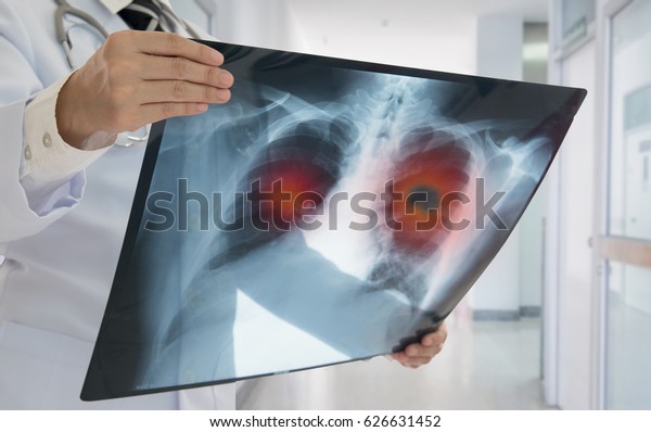 Lung Cancer or Pneumonia. Doctor check\
up x-ray image have problem lung tumor of\
patient.