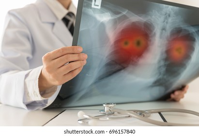 Lung Cancer Or Pneumonia. Doctor Radiology Check Up Xray Image Have Problem Lung Tumor Of Patient In Clinic Room.