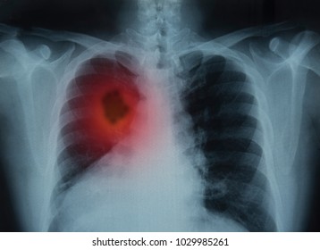 Lung Cancer Or Pneumonia. X-ray Image Of Patient Lungs To Lung Tumor.