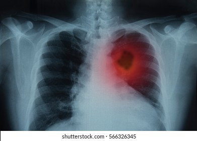 Lung Cancer or Pneumonia. X-ray image of patient lungs to lung tumor.