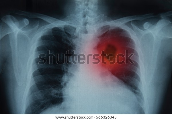 Lung Cancer or Pneumonia. X-ray image of patient\
lungs to lung tumor.