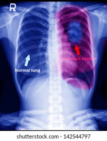 Lung Cancer In Women