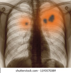 Lung Cancer,Pneumonia Or Emphysema. Xray Image Of Chest Patient.