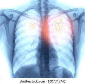 Lung Cancer,Pneumonia Or Emphysema . X-ray Image Of Patient Chest For Check Up Lung Disease.