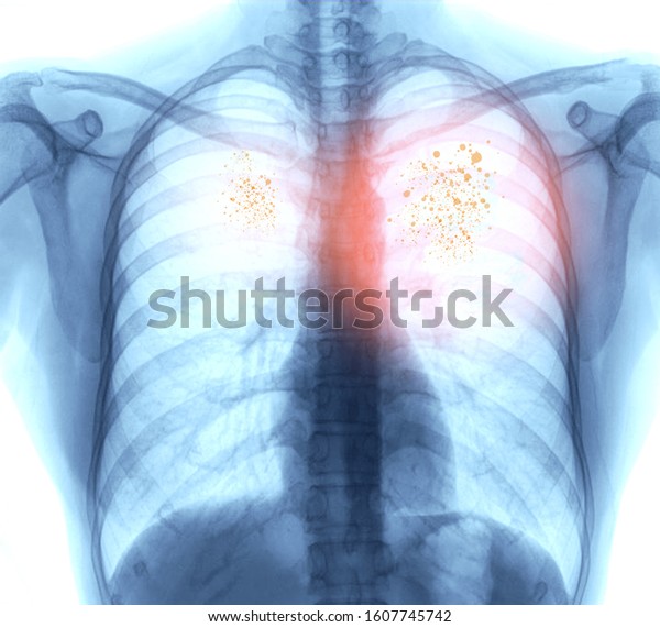 Lung Cancerpneumonia Emphysema Xray Image Patient Stock Photo (Edit Now ...