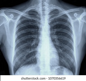 Lung Chest X-ray Image Of Patient By Mri Scanner For Medical Diagnose.