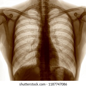 Lung Chest X-ray Image Of Patient By Ct Scan For Medical Diagnose.