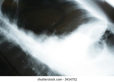 Lung Disease