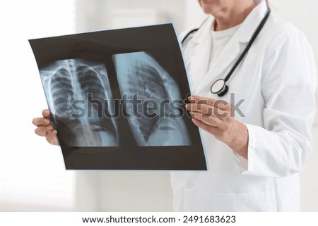 Lung disease. Doctor examining chest x-ray in clinic, closeup