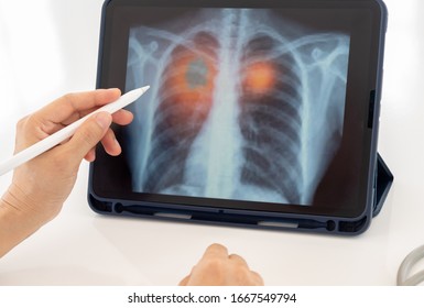 Lung Disease,Pneumonia. Doctor Check Up Patient Chest X-ray Image On Digital Tablet.