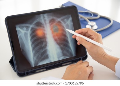 Lung Disease,Pneumonia,Lung Cancer. Doctor Check Up X-ray Image Have Problem Lung Tumor Of Patient.