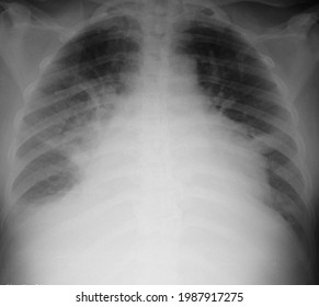 Lung Edema Radiology Chest Xray