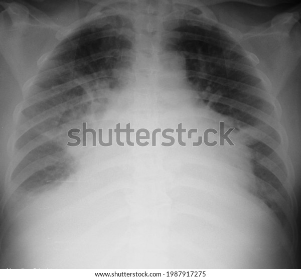 Lung Edema Radiology Chest Xray Stock Photo 1987917275 | Shutterstock