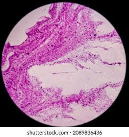 Lung mass(CT Guided FNA): Inflammatory lesion, microscopy show polymorphs, lymphocytes, histiocytes, reactive bronchial cells. No malignant cell.