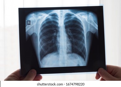 Lung Radiography Concept. Radiology Doctor Examining At Chest X Ray Film Of Patient Lung Cancer Or Pneumonia. Virus And Bacteria Infected The Human Lungs. Patient With Lung Cancer Or Pneumonia.