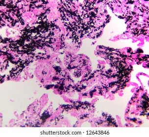 23 Anthracosis Images, Stock Photos & Vectors | Shutterstock