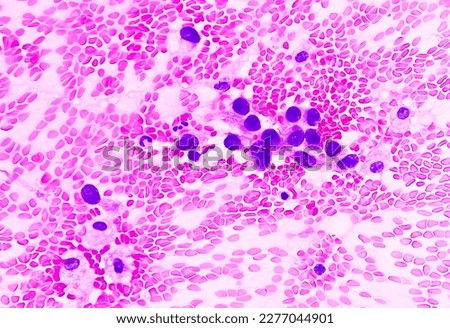 Lungs adenocarcinoma. Malignant cell. Smear show cellular material of atypical epithelial cells, cell show pleomorphism with prominent nuclei and cytoplasm. Lungs cancer. color adjust.