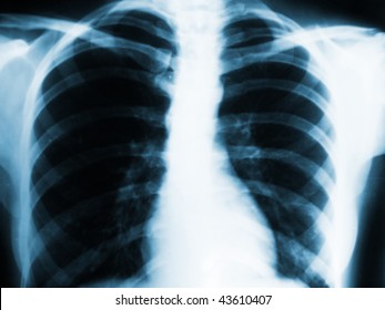 Lungs Xray