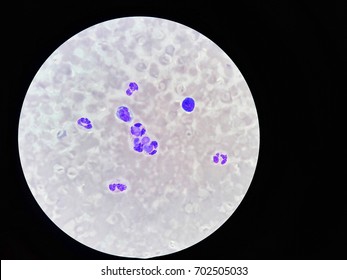 Lupus Erythematosus Cells (LE Cells) On 100X Light Microscop Stain.
