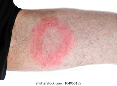 Lyme disease, Borreliosis or Borrelia, typical spot.