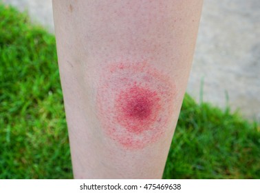 Lyme disease, Borreliosis or Borrelia, typical lyme rash, spot. A person, leg bitten by a deer tick. Selective focus.