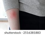 Lyme disease rash on arm after tick bite