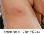 Lyme disease symptoms after tick bite. Woman with Lyme disease develop an erythema migrans rash, usually about a week after the tick bite.