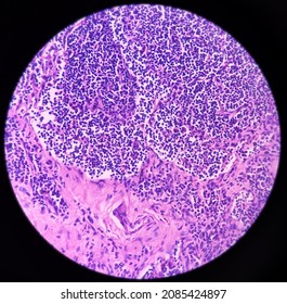 Lymph Angioma, Photomicrograph Of Lymphangioma(cystic Hygroma) Or Lymphatic Malformation, Benign Lesions,  Noncancerous, Fluid-filled Cysts That Occur In Lymphatic Vessels.