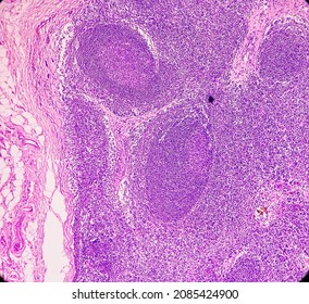 Lymph Angioma, Photomicrograph Of Lymphangioma(cystic Hygroma) Or Lymphatic Malformation, Benign Lesions,  Noncancerous, Fluid-filled Cysts That Occur In Lymphatic Vessels.