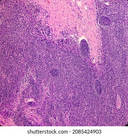 Lymph Angioma, Photomicrograph Of Lymphangioma(cystic Hygroma) Or Lymphatic Malformation, Benign Lesions,  Noncancerous, Fluid-filled Cysts That Occur In Lymphatic Vessels.