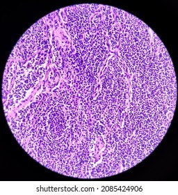 Lymph Angioma, Photomicrograph Of Lymphangioma(cystic Hygroma) Or Lymphatic Malformation, Benign Lesions,  Noncancerous, Fluid-filled Cysts That Occur In Lymphatic Vessels.