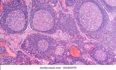 Lymph Node Biopsy: Microscopic Image (photomicrograph) Of A Lymph Node From A Patient With Enlarged Nodes (lymphadenopathy), Showing Benign Follicular Hyperplasia, A Reactive Change. 