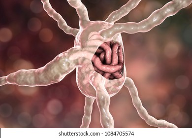 Lymph node with filaria worms, concept of elephantiasis, or lymphatic filariasis, 3D illustration. A disease caused by nematode worms Wuchereria bancrofti and other, transmitted by mosquito bite