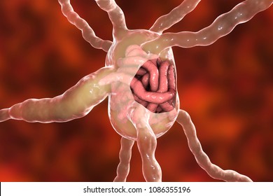 Lymph node with filaria worms, concept of elephantiasis, or lymphatic filariasis, 3D illustration. A disease caused by nematode worms Wuchereria bancrofti and other, transmitted by mosquito bite
