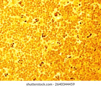 Lymph node. Light micrograph showing large macrophages full of dark phagocytosed cell debris dispersed among lymphocytes. Semithin resin section 0.5 micrometres thick stained with silver.