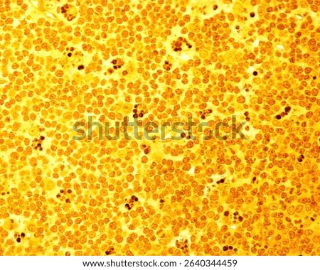 Lymph node. Light micrograph showing large macrophages full of dark phagocytosed cell debris dispersed among lymphocytes. Semithin resin section 0.5 micrometres thick stained with silver.