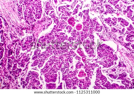 Lymph node metastasis, light micrograph of cancer that has spread to a lymph node