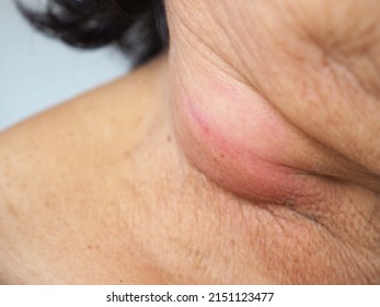 Lymph nodes swollen, lymphoma  or inflamed lymph nodes, closeup view of an adult with sore throat or pain on the neck. health concept. - Shutterstock ID 2151123477